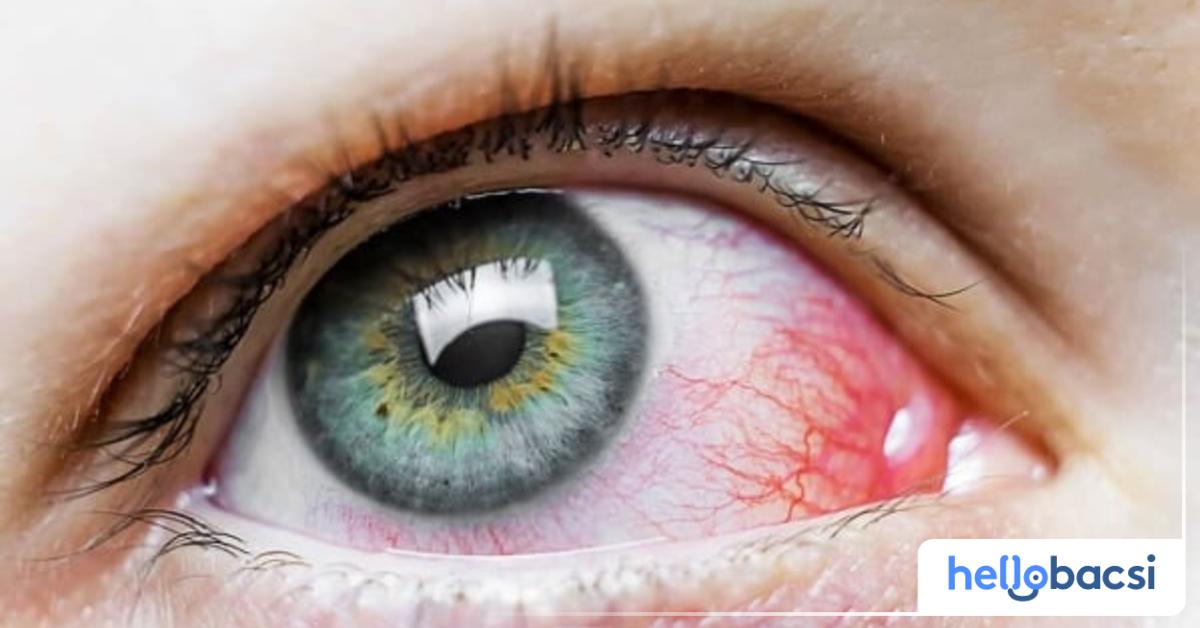 Đỏ khóe mắt liên quan đến những nguyên nhân gì?