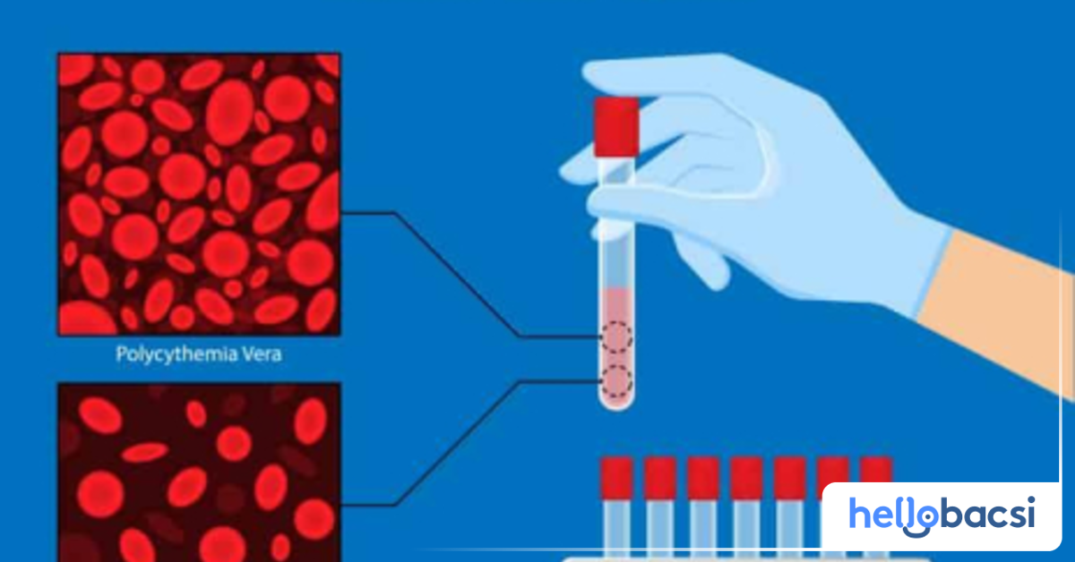 Cách chẩn đoán bệnh đa hồng cầu ra sao?

