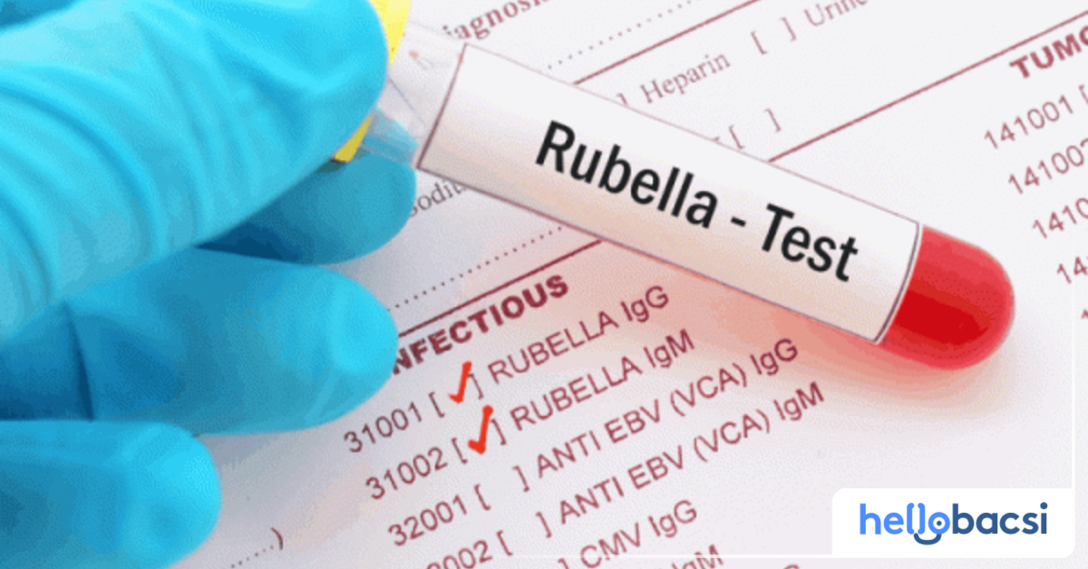 Chẩn đoán bệnh rubella chỉ số rubella igg 500 và những thông tin quan trọng