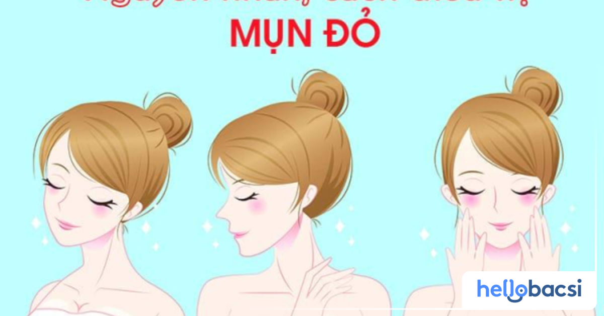 Làm thế nào để ngăn ngừa mụn bị đỏ xuất hiện?
