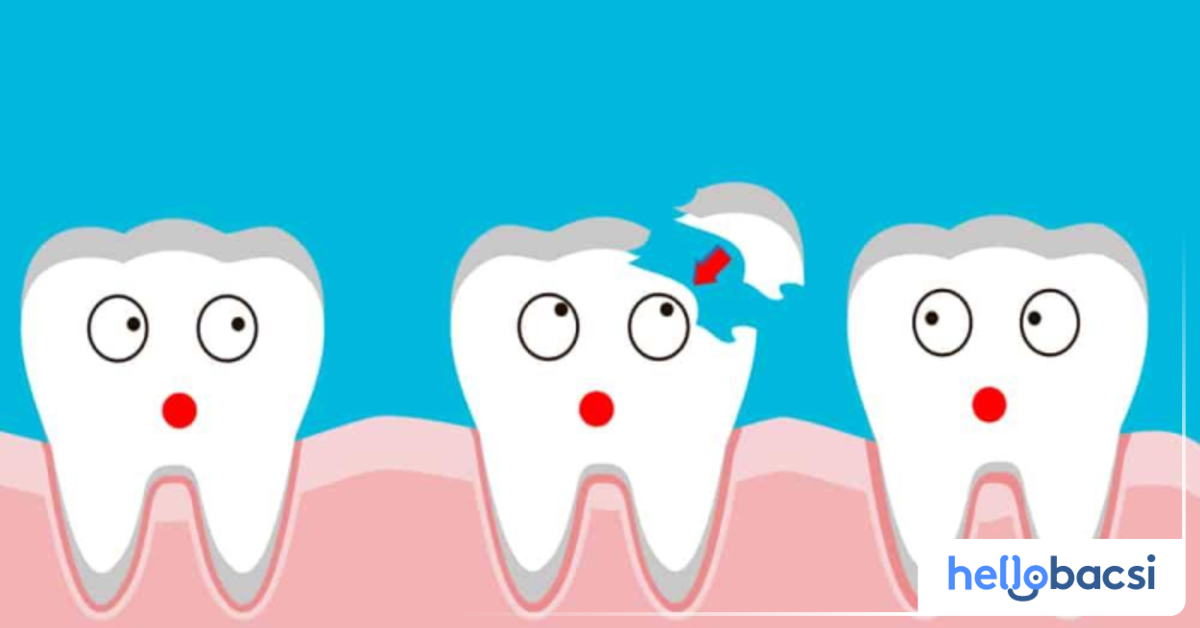 Consequences of leaving a cracked dental crown untreated?
