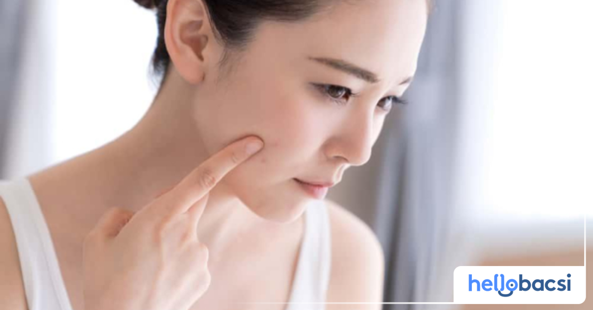 Acnes Care có tác dụng gì trong việc trị mụn? 
