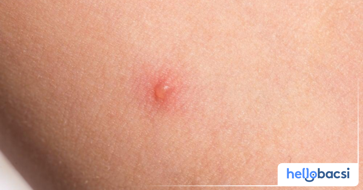 Có những bệnh lý nào khác có thể khiến da nổi mụn nước ở chân ngoài chàm eczema?
