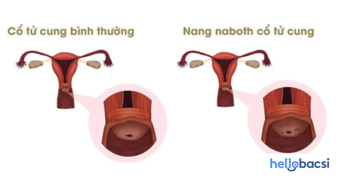 Có cách nào để điều trị nang naboth cổ tử cung không phẫu thuật?
