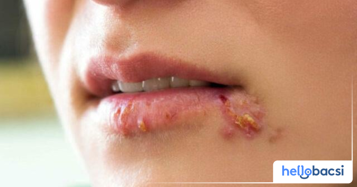 Herpes có liên quan đến bệnh lây truyền qua đường tình dục không?