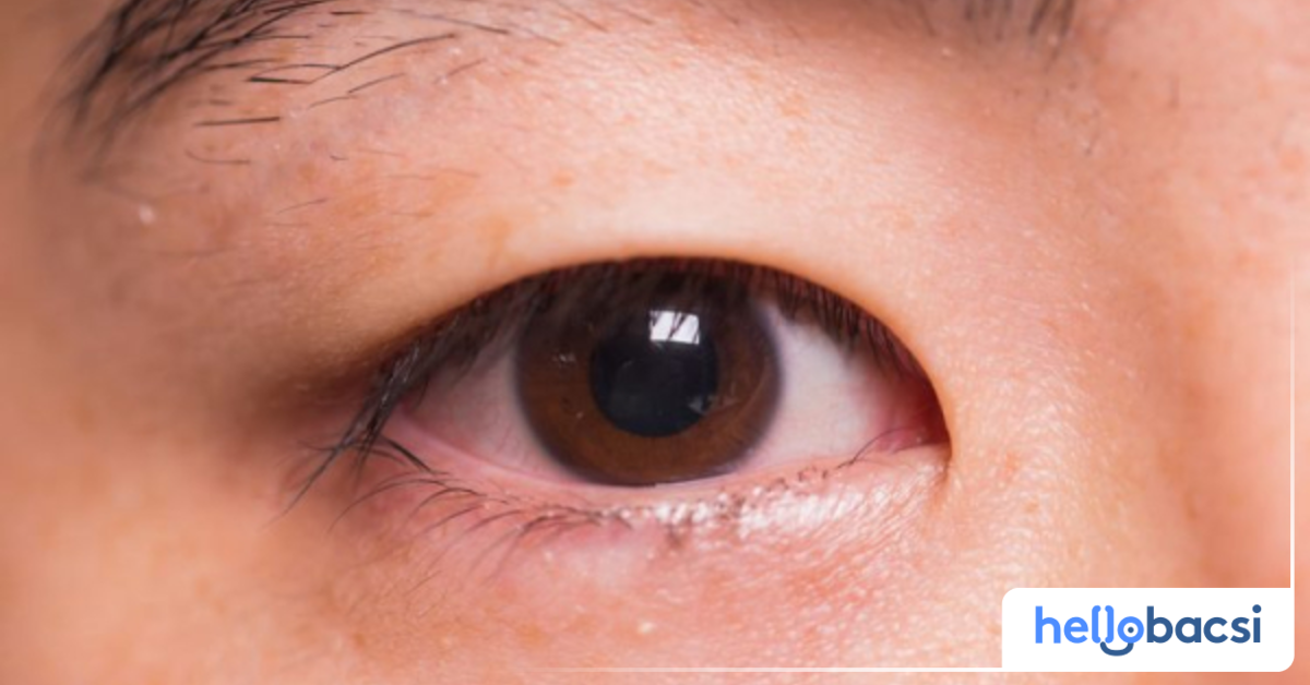 Cách điều trị lẹo mắt là gì?
