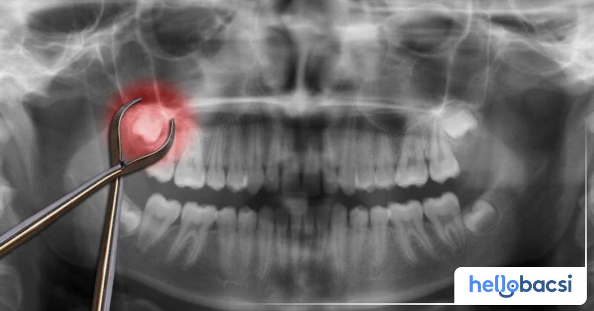 Tại sao răng khôn thường bị mắc kẹt?
